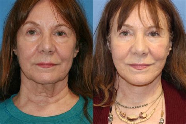 Joyce Meyer's Plastic Surgery: Before And After Transformation