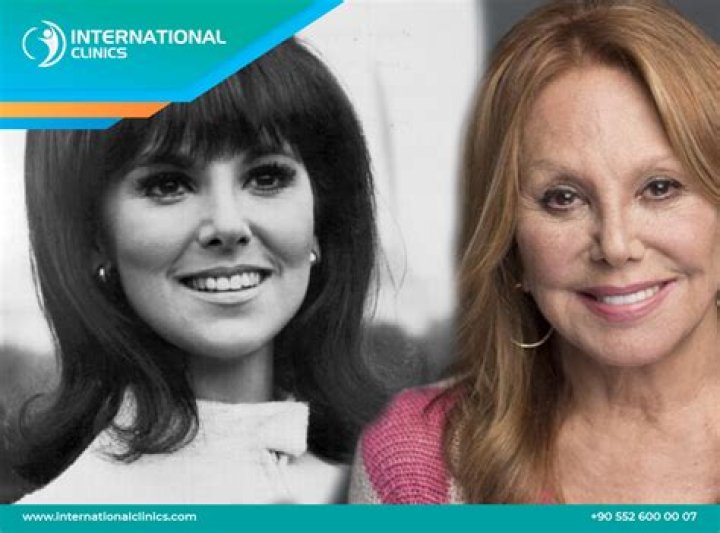 Marlo Thomas' Nose Transformation: Understanding The Changes