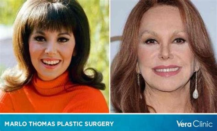 Marlo Thomas Plastic Surgery Before And After Nose Job Pictures Revealed!