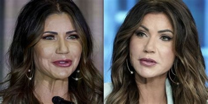 Profiling Kristi Noem's Plastic Surgery Enhancements