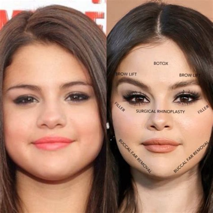 Selena Gomez Undergoes Eye Surgery: Reasons And Recovery