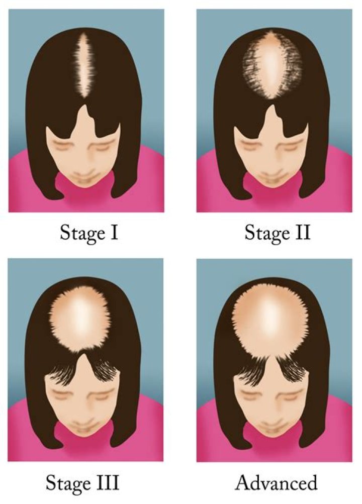The Shining Scalps: Balding Rappers Take Center Stage