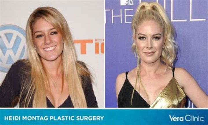 The Transformation Of Heidi: Before And After Plastic Surgery
