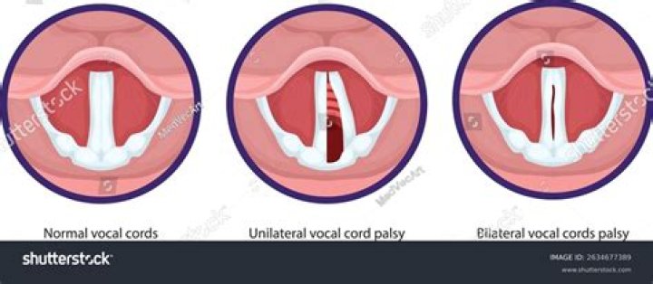 Understanding Kerry Kennedy's Vocal Condition: A Comprehensive Analysis